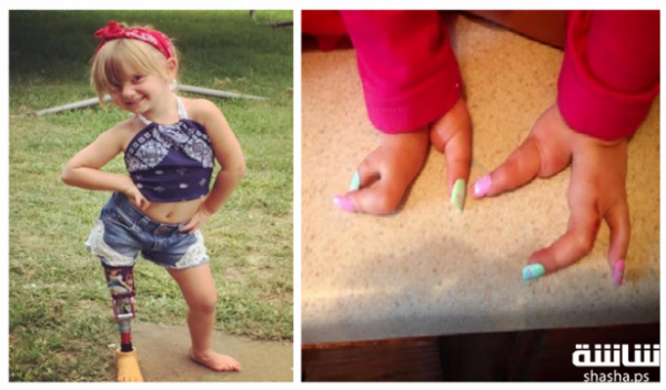 فيديو وصور: قطعوا ساقها قبل أن تبلغ العام.. إليكم ما حدث لها بعد سنتين!