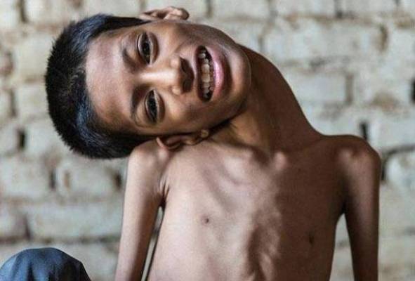 بالصور كيف أصبح طفل الرقبة الملتوية بعد اجراء عملية له؟
