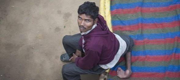 هندي بأربع أرجل يثير دهشة العالم