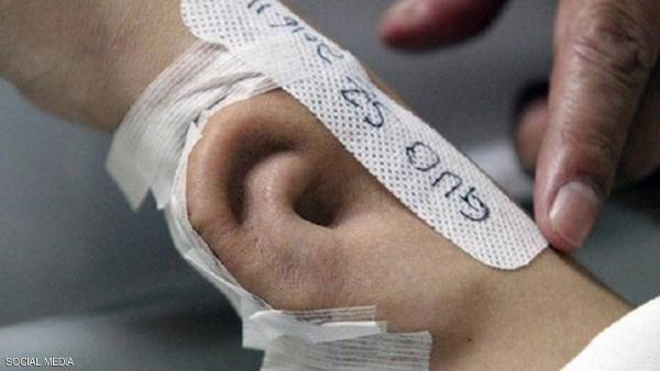 في الصين.. زراعة أذن في ذراع مريض