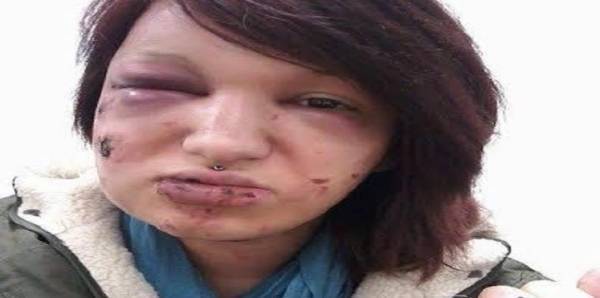 لسبب غريب.. بريطاني يعضّ صديقته 21 مرة من وجهها