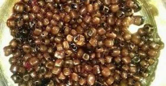 استخراج 475 حصاة من مرارة سيدة مصرية