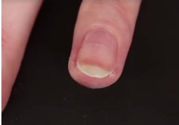 مفاجأة.. أكياس الشاي تصلح أظافرك المكسورة.. الطريقة أبهرت 36 مليون شخص