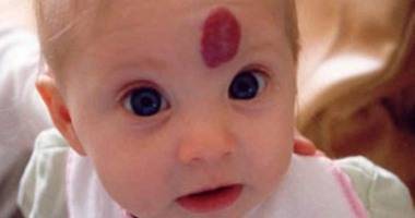 هل صحيح أن ‏الحامل‬ إذا اشتهت طعام ولم تأكله فإنه يظهر على شكل ‏وحمة؟!