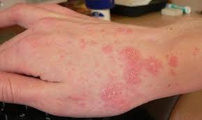 إصابة عشرات طلاب المدارس بمرض الجرب