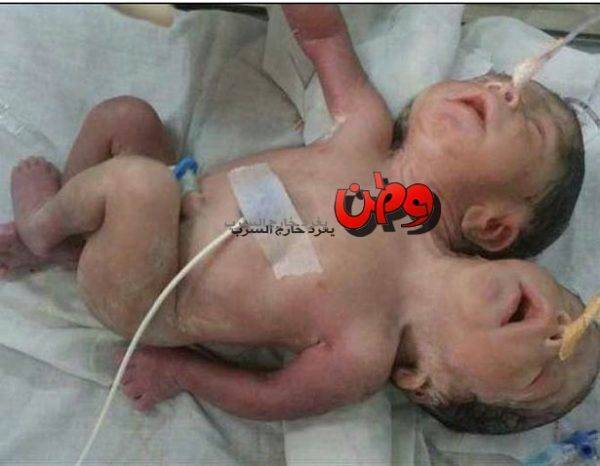 شاهد بالصور: أم تَلِد طفلاً برأسين وثلاثة أيدي!