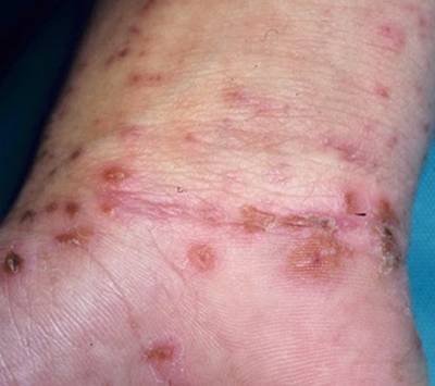 ارتفاع إصابات الجرب إلى 300 بالشمال