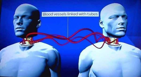 جراح إيطالي يحدد موعد إجراء أول عملية لزراعة رأس كامل