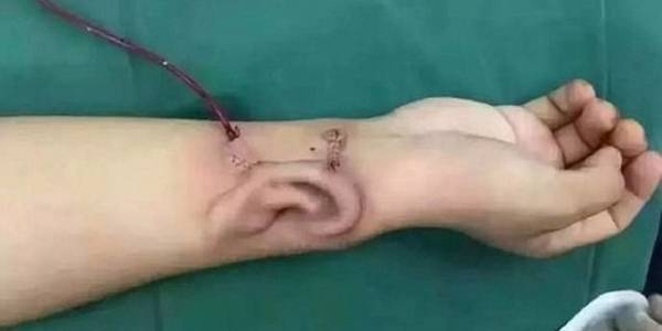 زراعة أذن في ذراع رجل قبل نقلها لرأسه.. استفاد الأطباء من تقنية ثلاثي الأبعاد، فيديو وصور