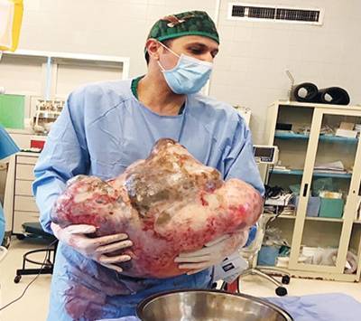 استئصال ورم يزن 33 كيلوغراما من اردنية