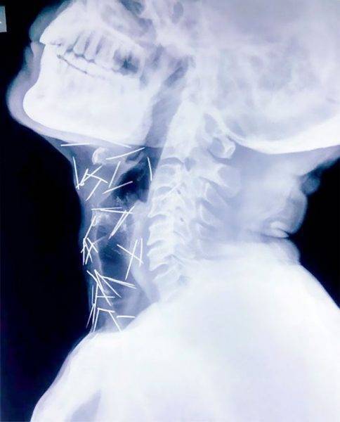 بالصور: لن تُصدّقوا .. كيف دخل 75 مسماراً داخل جسد هذا الرجل!