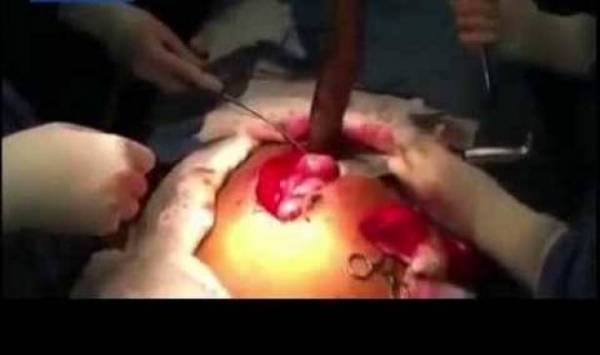 لن تصدقوا ماذا أخرجوا من معدته!