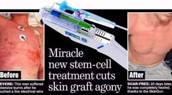 مسدس سحري يزرع بشرة جديدة لضحايا الحروق!