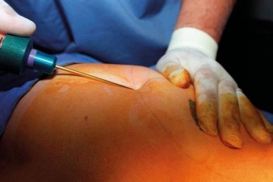 وفاة أردنية أجرت عملية شفط في لبنان