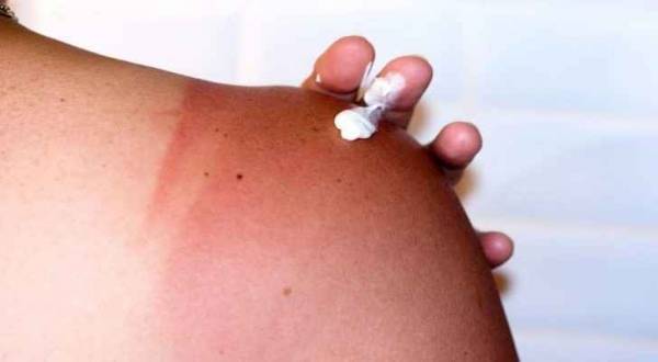 نصائح لعلاج حروق الشمس في فصل الصيف