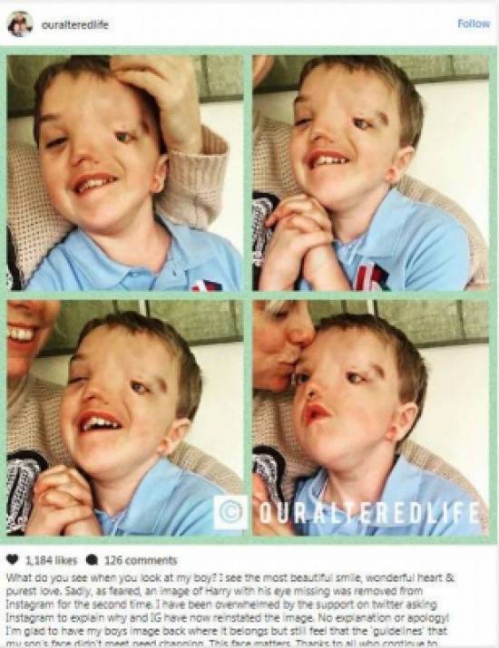 إنستغرام يحذف صورة طفل مصاب بتشوه.. ووالدته تخضع الشركة!