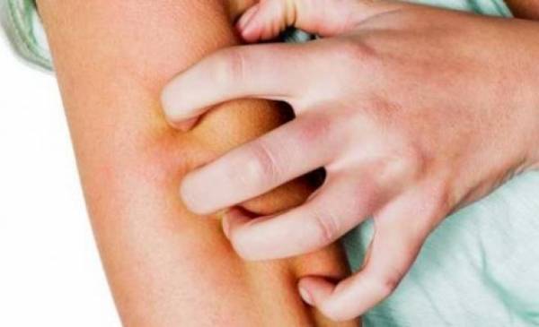 إربد: 19 إصابة بمرض الجرب في بني كنانة