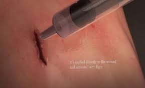 غراء طبي يغلق الجروح خلال 60 ثانية