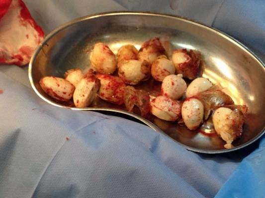 الأشغال الشاقة لأجانب وأردنيين هربوا مخدرات عبر أمعائهم إلى المملكة