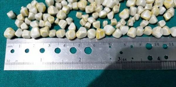 في عملية نادرة.. إزالة 148 حصوة من مرارة امرأة هندية