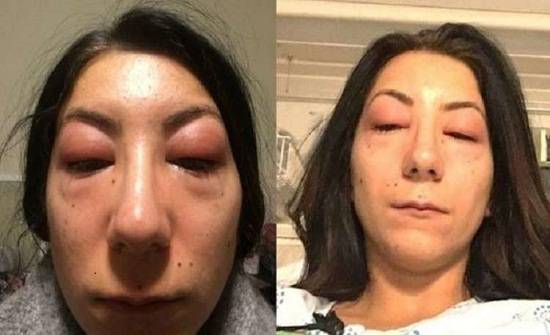 جاءت لتكحّلها فأعمتها.. هذه قصة إيزابيل مع التجميل