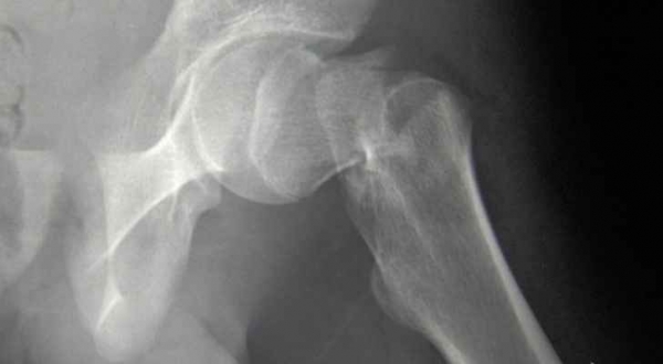 القلق يضعف عظام السيدات