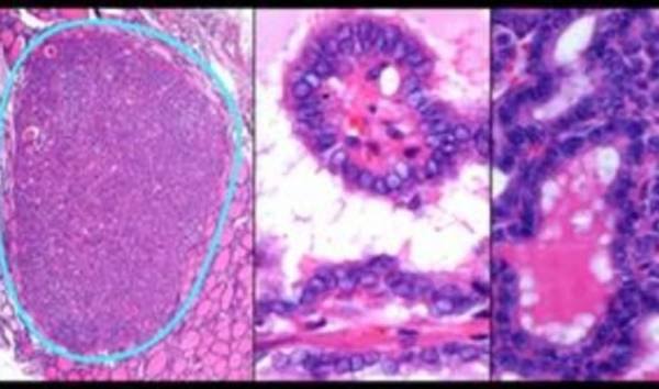 بشرى جديدة.. السرطان قابل للشفاء