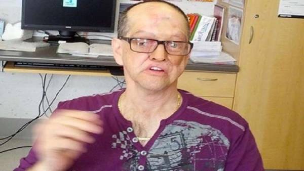 كندي ينتصر على السرطان ويفقد نصف وجهه