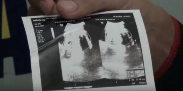 ولادة طفل غريب في أندونيسيا (فيديو)