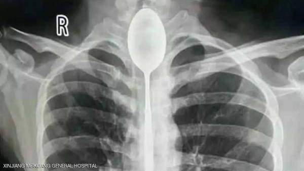 صيني ابتلع ملعقة وحدث ما لا يمكن تصوره