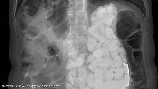 رجل يصدم الأطباء بـمقتنيات غريبة في معدته