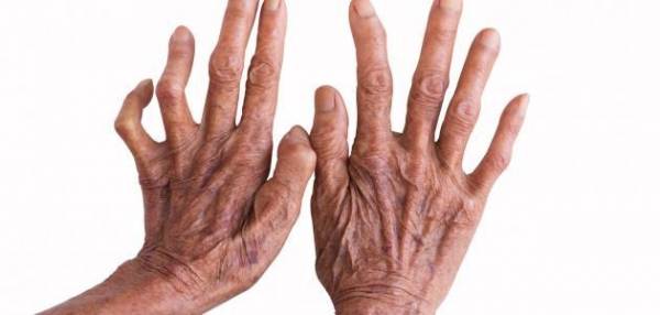 الصحة توضح حقيقة العثور على اصابات بمرض الجذام في الاردن عاجل