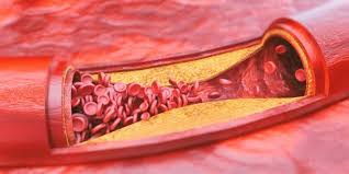 العلماء يحددون أخيرا الآلية الغامضة المسببة لتصلب الشرايين