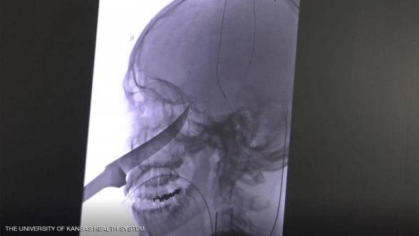 سكين طوله 25 سنتيمترا في الجمجمة.. كيف نجا هذا المراهق؟