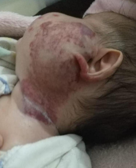 علاج وحمة دموية مستعصية في مستشفى الأمير علي