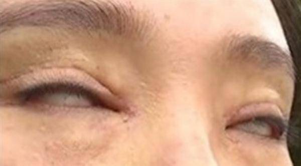 عملية تجميل .. تحرمها من إغلاق عينيها