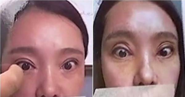 عملية تجميل تحرم سيدة من إغلاق عينيها