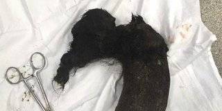 عملية جراحية ناجحة لفتاة تأكل شعرها