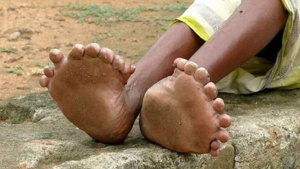 هندية بـ31 إصبعا حبيسة منزلها لاعتبارها ساحرة