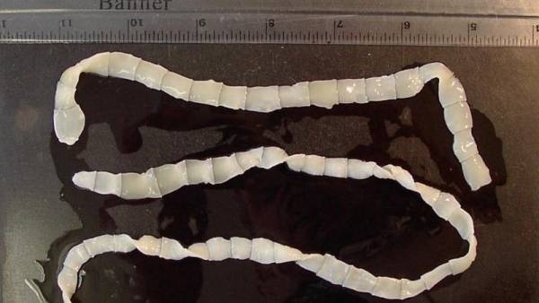 اكتشاف 700 دودة شريطية في دماغ صيني