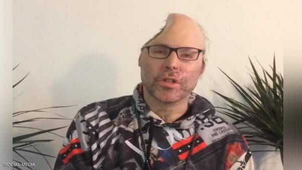 مطرب راب يتحدث لأول مرة بعد أن فقد نصف رأسه