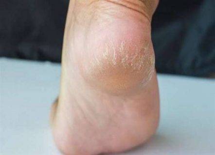 علاجات طبيعية لتشقق الكعبين أثبتت فاعليتها