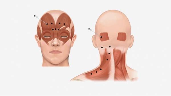 5 آثار جانبية للبوتوكس يجب أن تعرفها