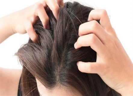 5 أسباب لحكة فروة الرأس