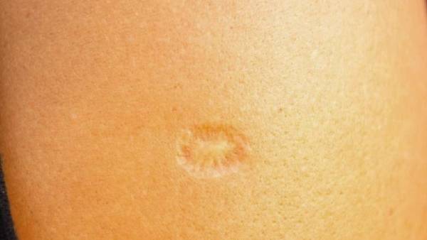 دراسة: إذا كانت بذراعك هذه العلامة فقد تبعدك عن مخالب كورونا .. صور و فيديو