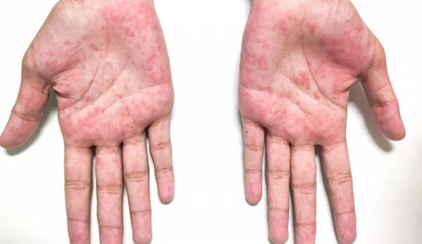 ماذا تعرف عن مرض كاواساكي وما علاقته بكورونا لدى الأطفال؟