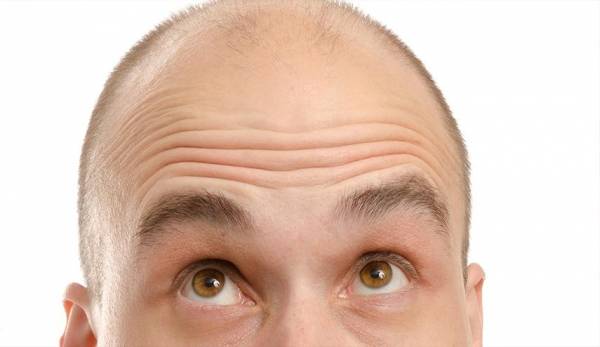 ما العلاقة بين الصلع والاصابة بكورونا؟!