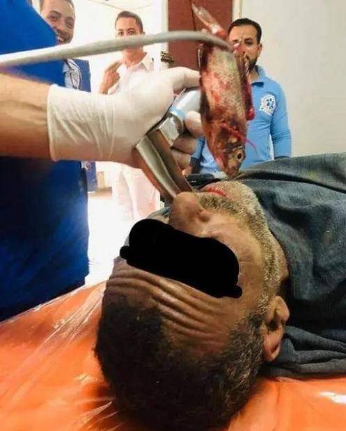 شاهد استخراج سمكة حية من مريء صياد مصري