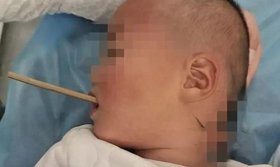 طفل ينجو من الموت بعد اختراق عصا حلقه