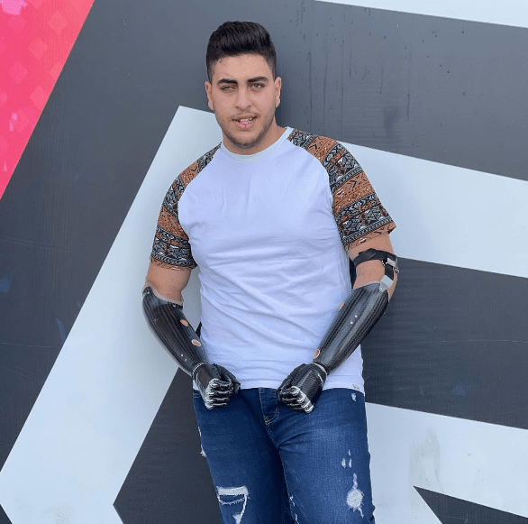 بعدما قطعت يداه وفقئت عينه.. فتى الزرقاء يتعايش مع ذراعين صناعيتين